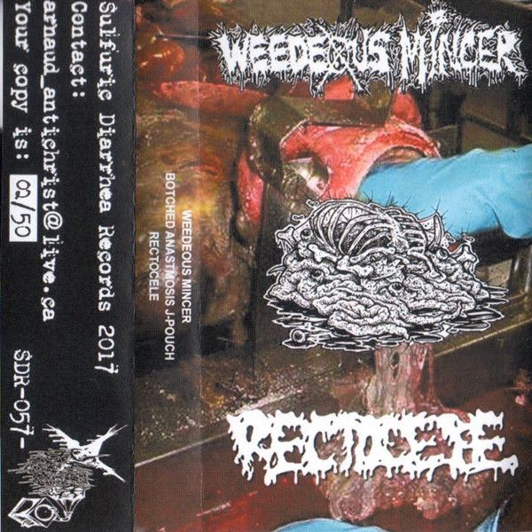 Weedeous Mincer / Botched Anastomosis J-Pouch / Rectocele