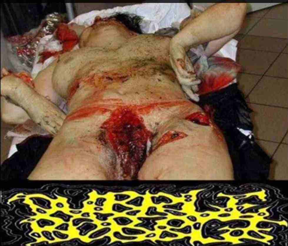 Genital Mutilations